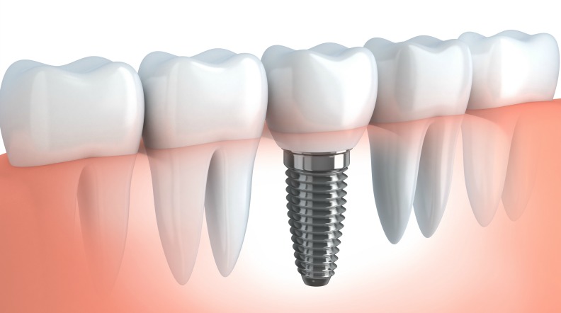 implantologia_dentale_studiodentisticopalmarini