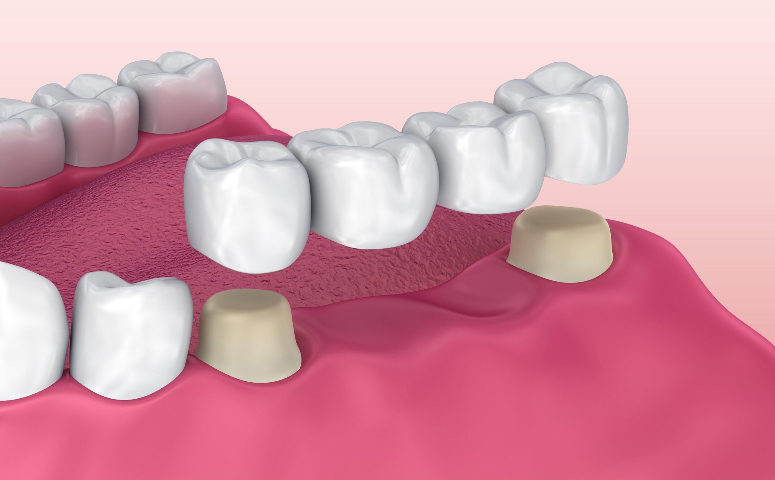 protesi_dentaria_studiodentisticopalmarini