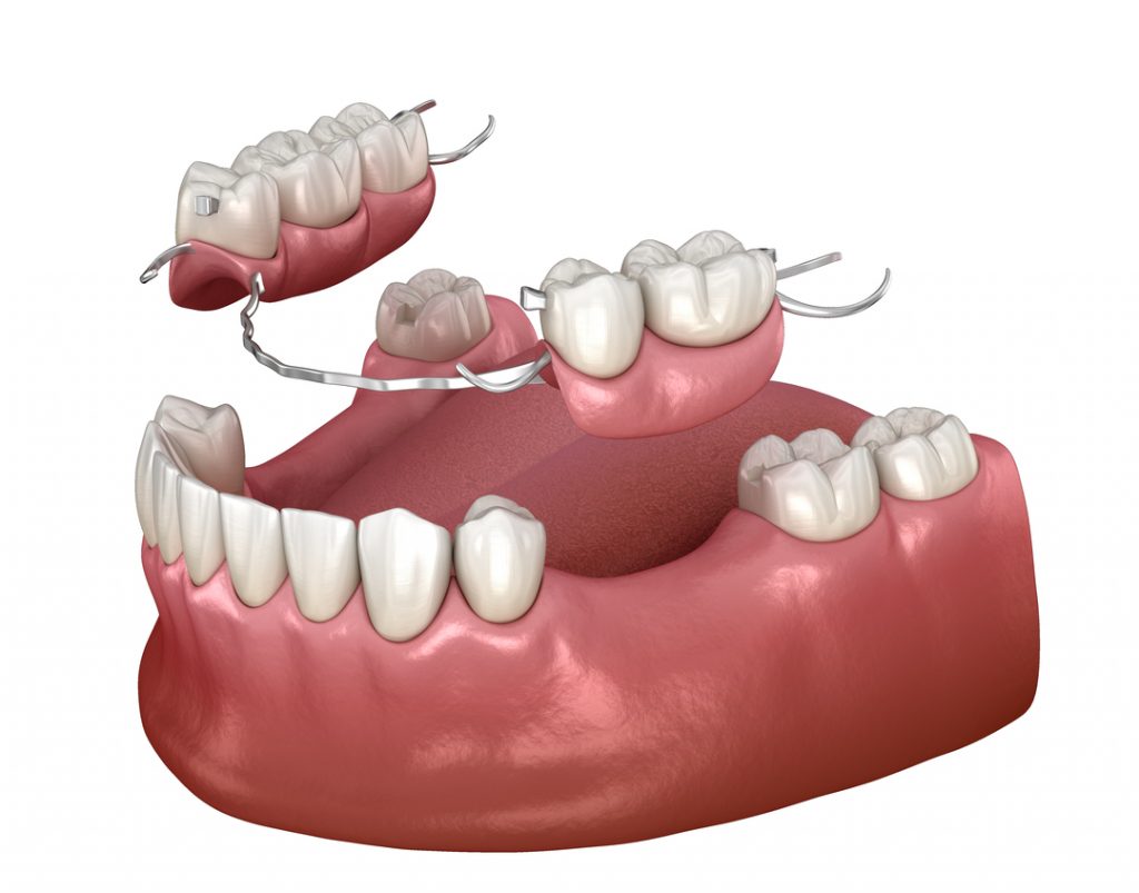 protesi_dentaria_studiodentisticopalmarini