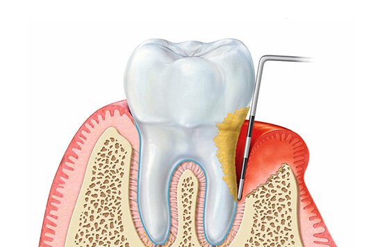 parodontologia_studiodentisticopalmarini